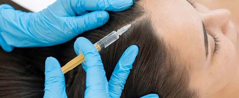 PRP Treatment for Hair Loss | Aesthetic Dermatology Clinic